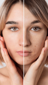 pigmentation treatment