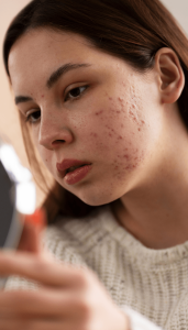 acne treatment